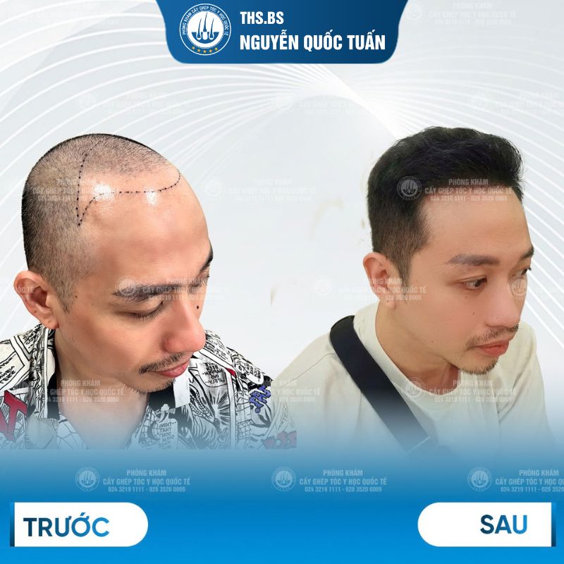 Cấy tóc mảng tại Phòng khám Cấy ghép tóc Y học Quốc tế 