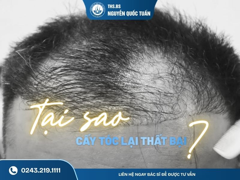 tại sao cấy tóc thất bại