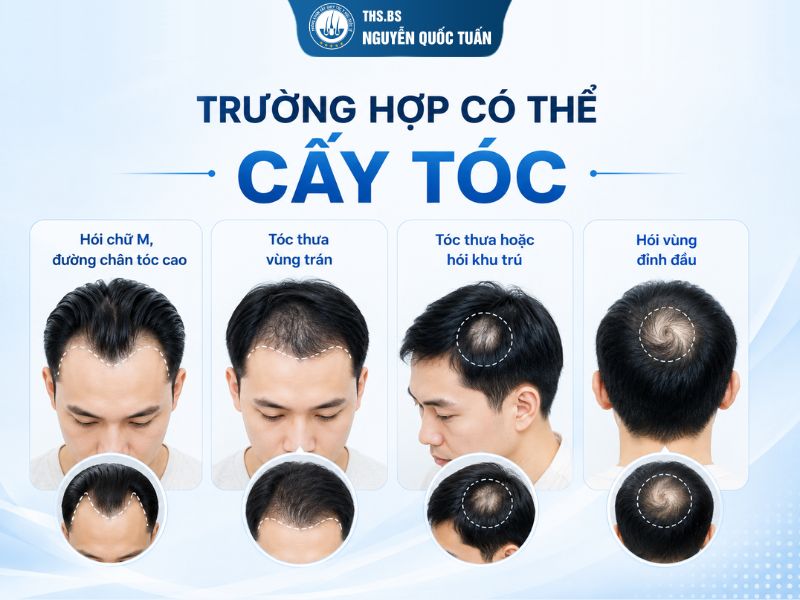 Cấy tóc sợi dài PNS phù hợp với những ai? 