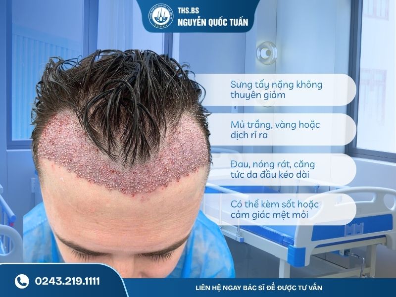 Vì sao bị nhiễm trùng sau khi cấy tóc
