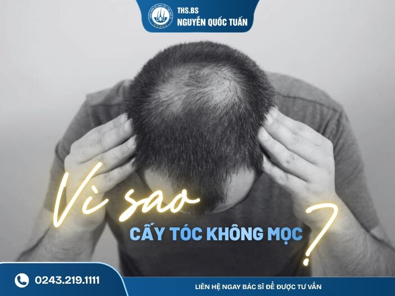 Vì sao cấy tóc không mọc 