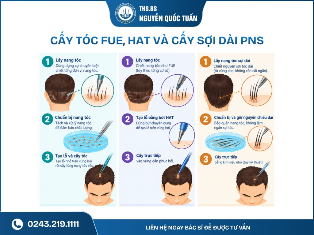 3 công nghệ cấy tóc phổ biến và sự khác biệt về chi phí