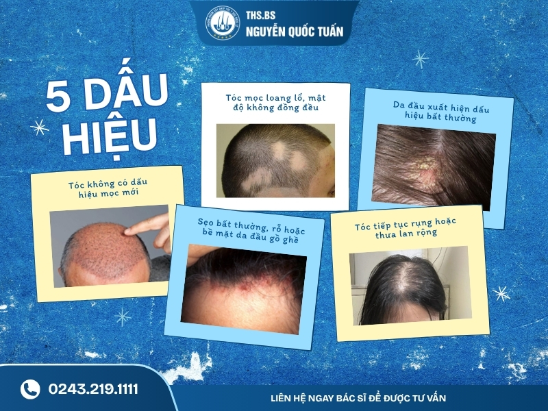 5 dấu hiệu tóc thưa sau cấy cần được bác sĩ kiểm tra