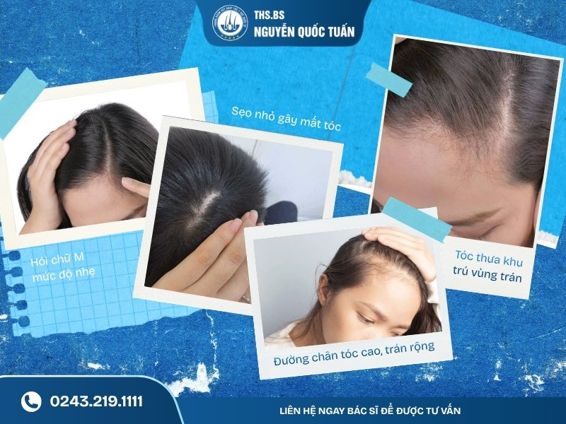 4 trường hợp có thể cấy tóc với ngân sách 50 triệu  