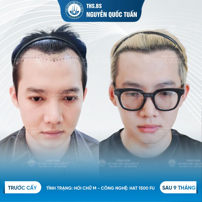 Kết quả cấy tóc sau 9 tháng tại Trung Tâm Cấy Tóc Y Học Quôc Tế  