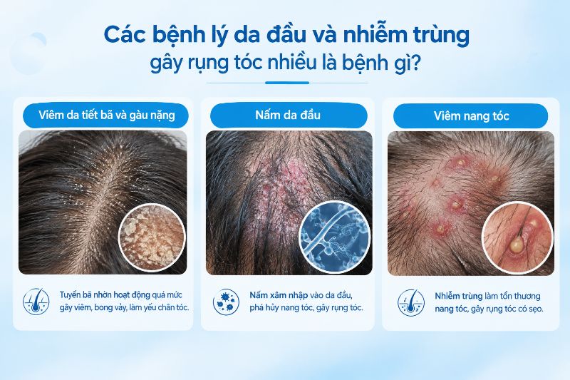 Các bệnh lý da đầu và nhiễm trùng gây rụng tóc nhiều là bệnh gì 