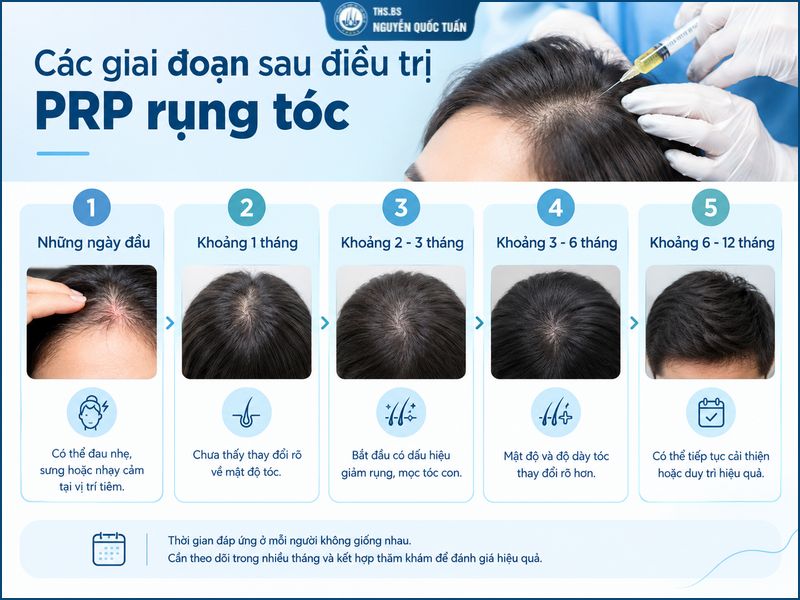 Các giai đoạn sau điều trị PRP rụng tóc 