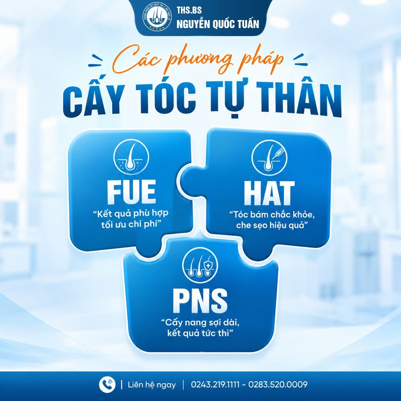 3 công nghệ cấy tóc đang được quan tâm tại HCM 