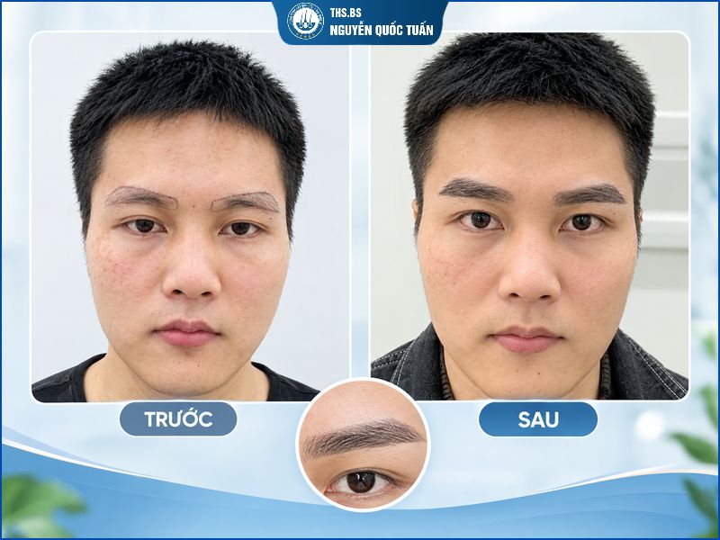 Cải thiện dáng mày mất cân đối tại Trung Tâm Cấy Tóc Y Học Quốc Tế