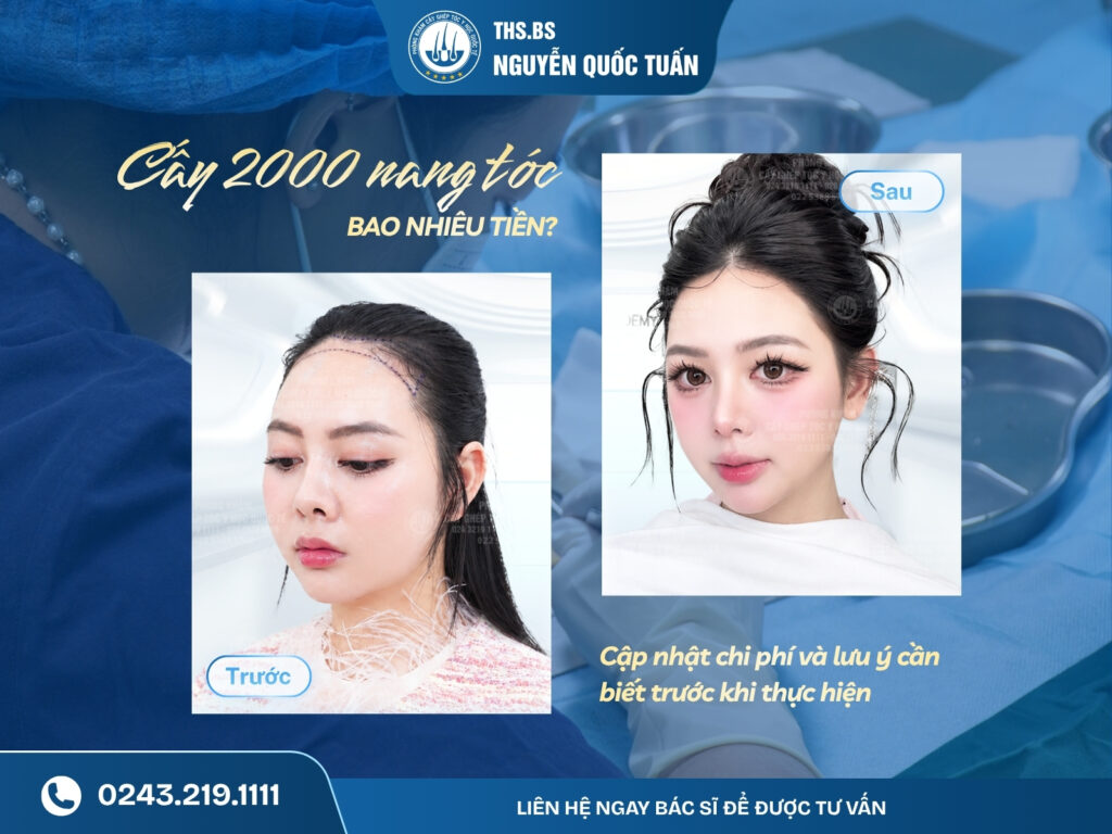 cấy 2000 nang tóc bao nhiêu tiền