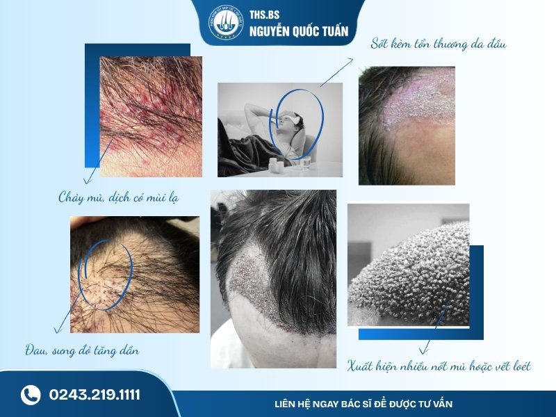Cấy tóc 1 tháng chưa mọc: Khi nào cần kiểm tra?  