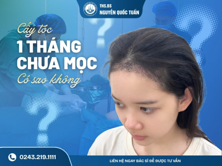 cấy tóc 1 tháng không mọc