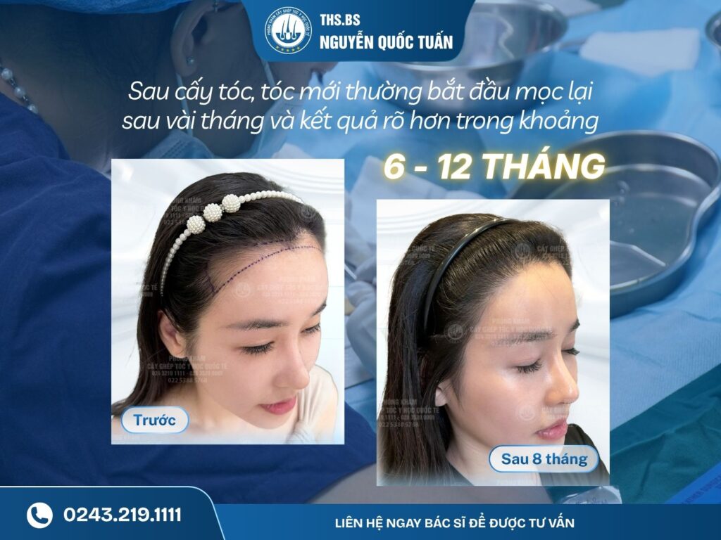  Cấy tóc có bền không? Vì sao tóc cấy có thể duy trì lâu dài? 