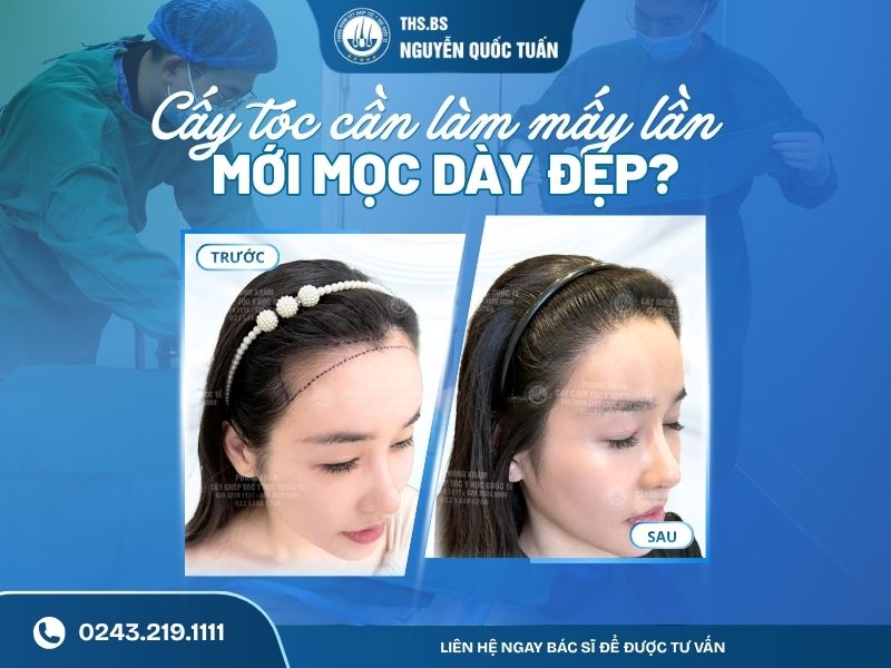 cấy tóc làm mấy lần mới mọc dày đẹp