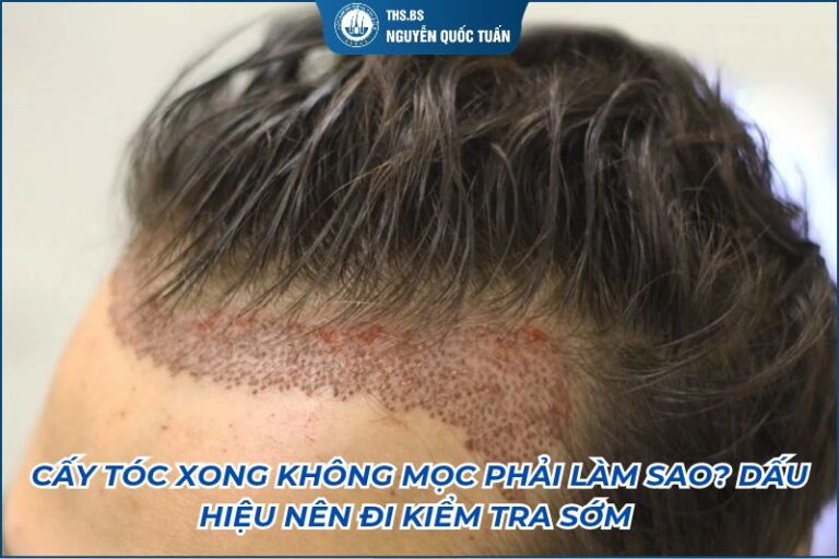cấy tóc xong không mọc phải làm sao