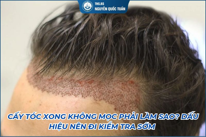 cấy tóc xong không mọc phải làm sao