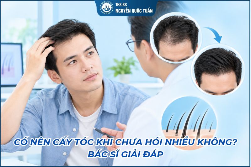 có nên cấy tóc khi chưa hói nhiều không