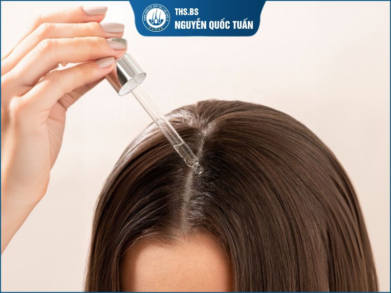 Có nên dùng thuốc kích mọc tóc sau cấy tóc không? 