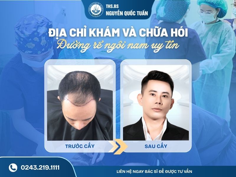 Địa chỉ khám và chữa hói đường rẽ ngôi nam uy tín, hiệu quả  