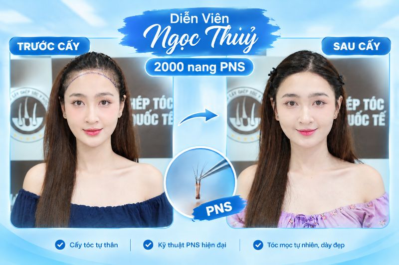 Chi phí cấy tóc có tương xứng với chất lượng 