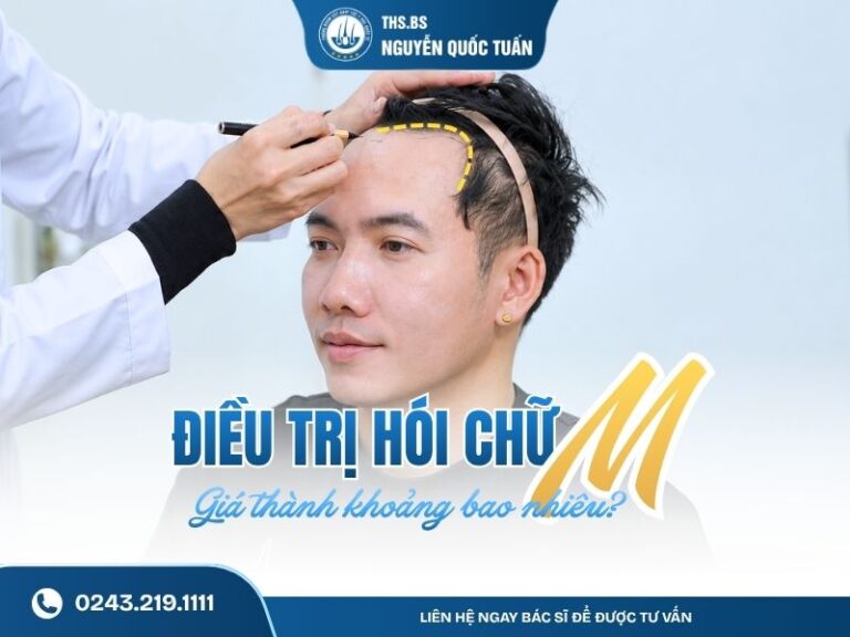 điều trị hói chữ m