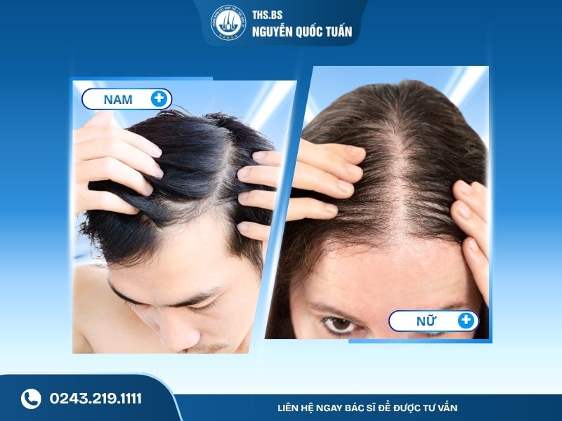Hói đường rẽ ngôi nam khác gì với nữ giới 
