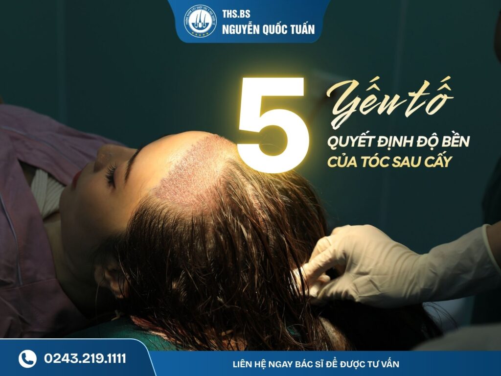 Những yếu tố quyết định độ bền của tóc sau cấy 