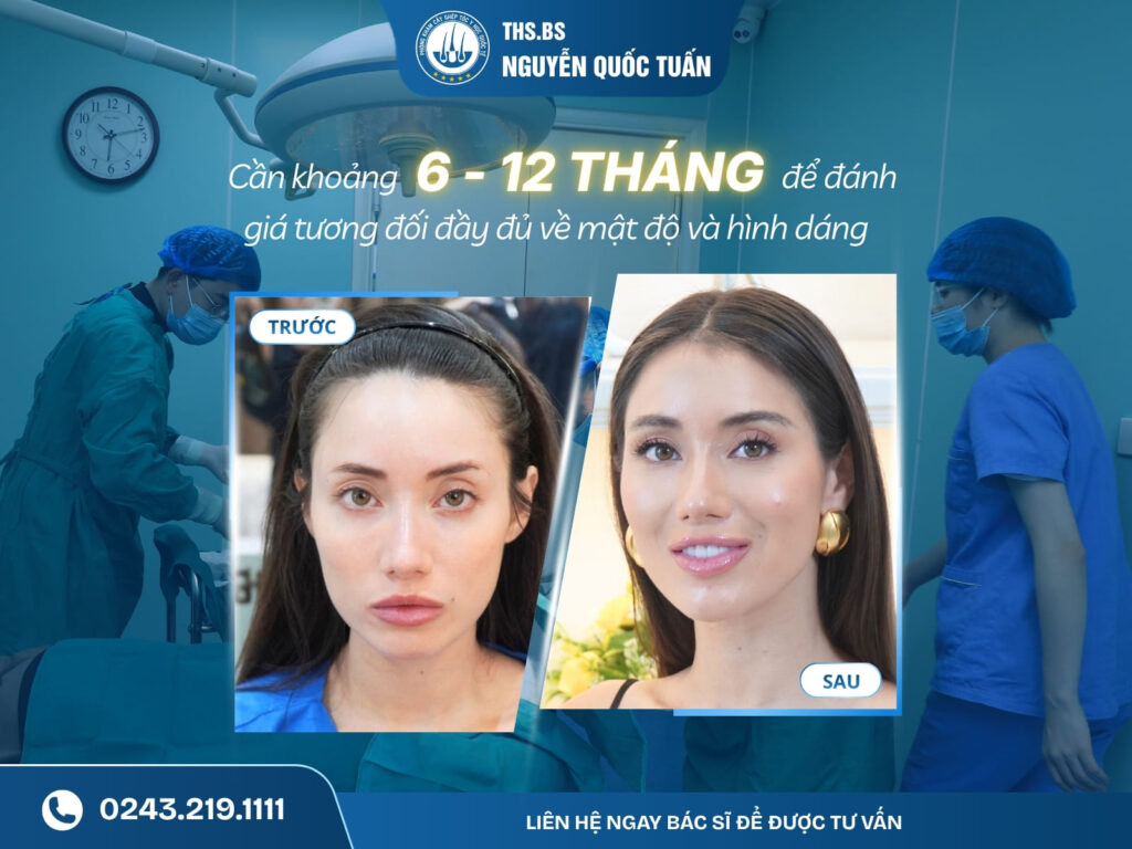 Cấy lông mày được bao lâu? Khi nào thấy kết quả?  