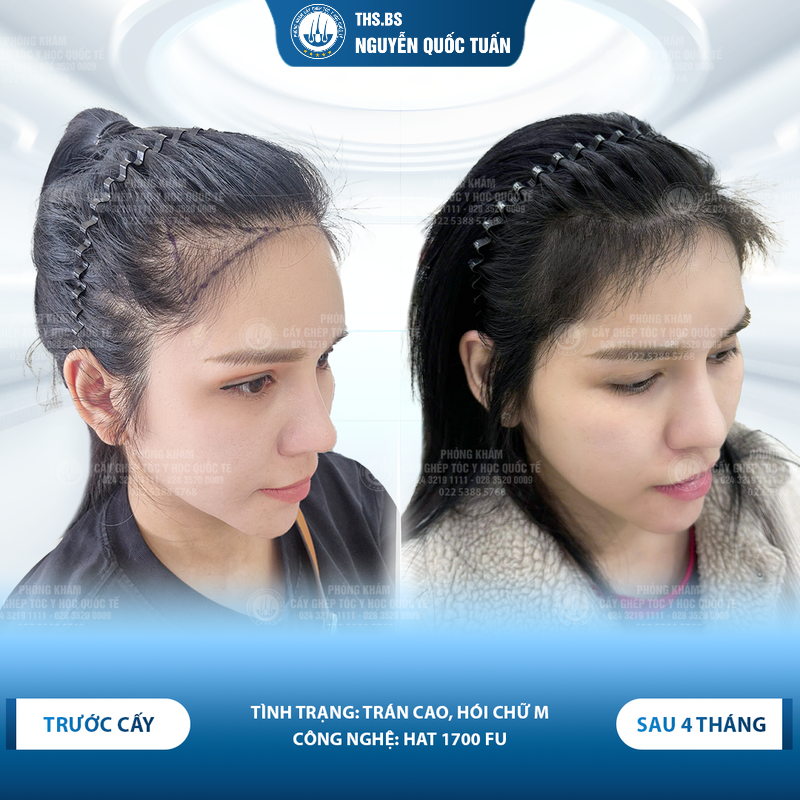 Hiệu quả thực tế của PRP trong phác đồ chăm sóc hậu cấy 