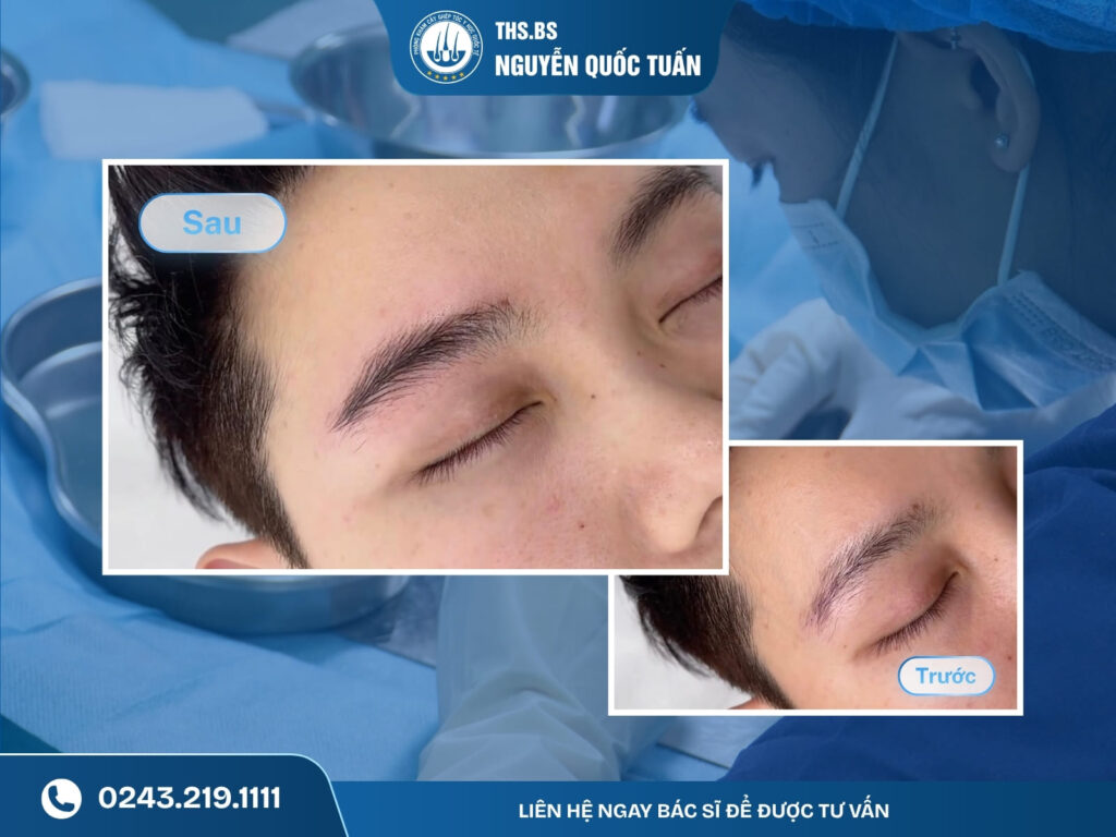 Kết quả cấy lông mày tự thân tại Phòng Khám Cấy Tóc Y Học Quốc Tế