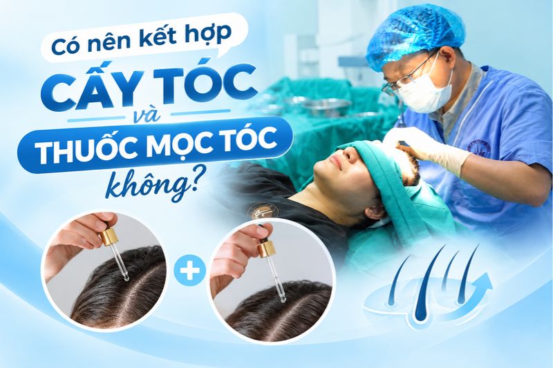  Có nên kết hợp cấy tóc và thuốc mọc tóc không 