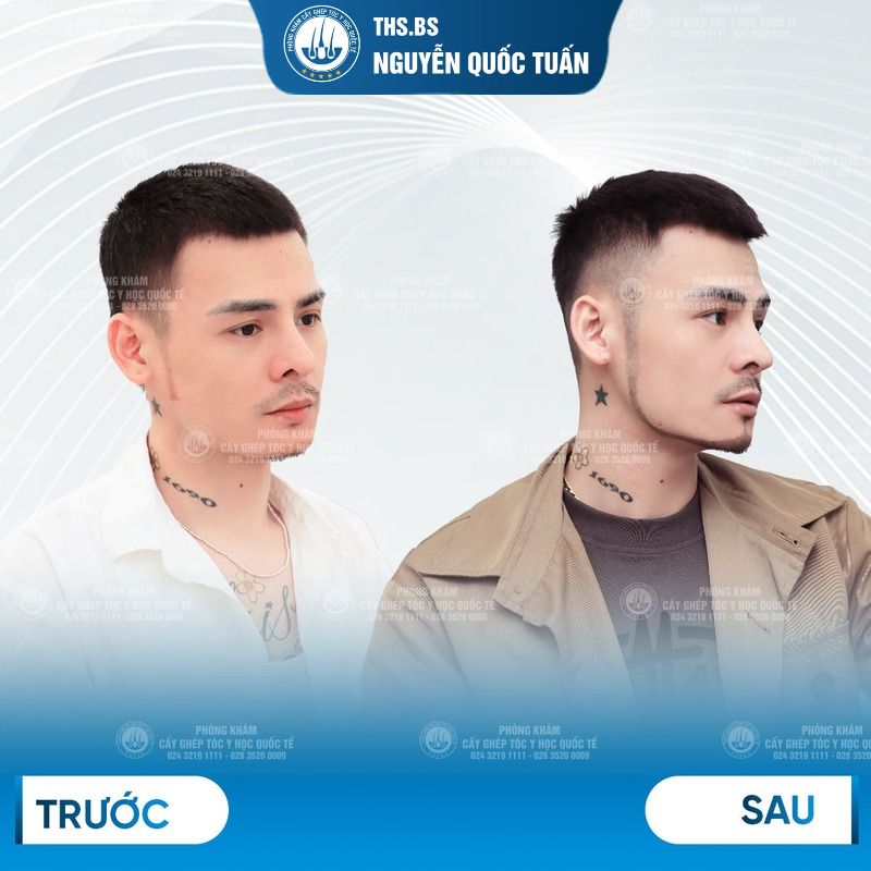 Cấy râu tự thân 