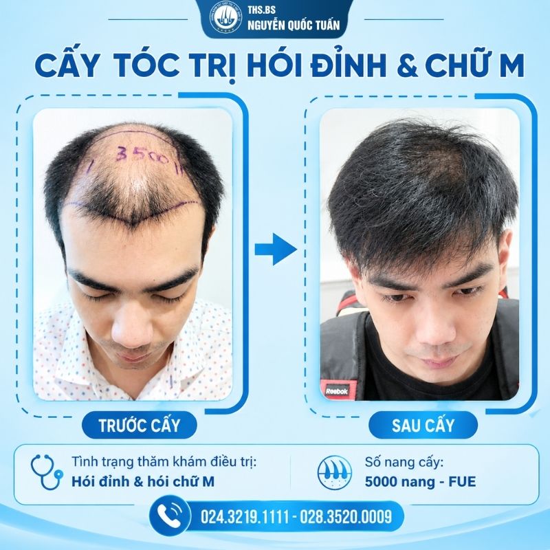 Kết quả sau cấy tại Trung Tâm Cấy Tóc Y Học Quốc Tế  