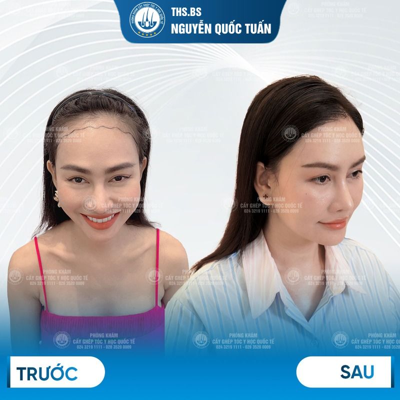 Kết quả sau cấy tóc tự thân tại Phòng Khám Cấy Tóc Y Học Quốc Tế HCMv 