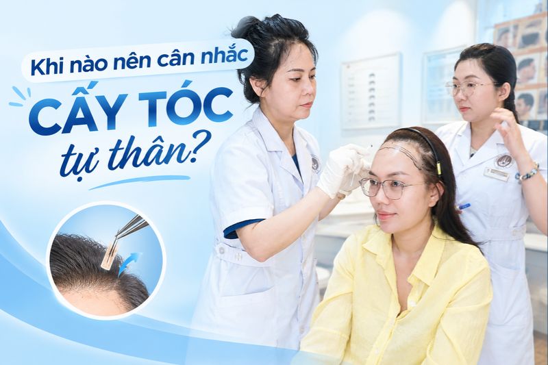 Khi nào nên cân nhắc cấy tóc tự thân  