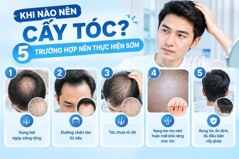 Khi nào nên cấy tóc? 5 trường hợp nên thực hiện sớm 