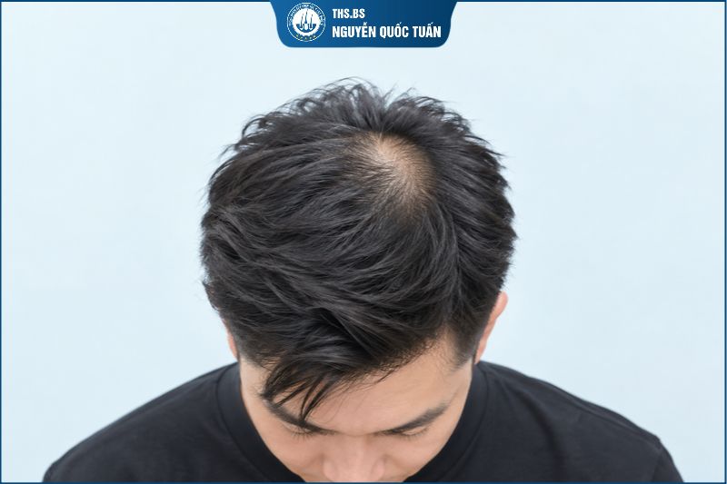  Những kiểu tóc người hói chữ O nên hạn chế 