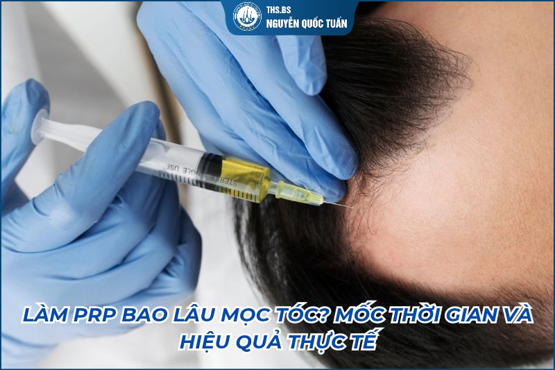 làm prp bao lâu mọc tóc