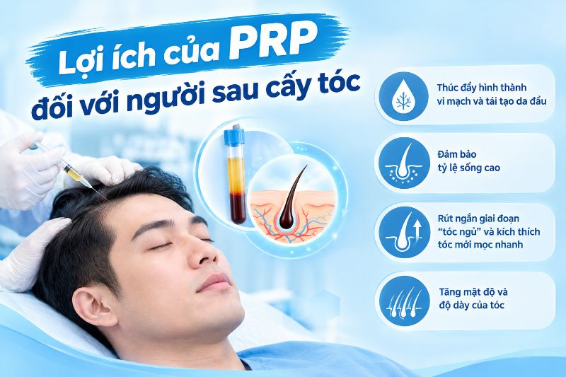 Lợi ích của PRP đối với người sau cấy tóc 