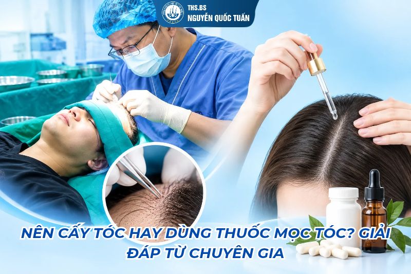 nên cấy tóc hay dùng thuốc mọc tóc