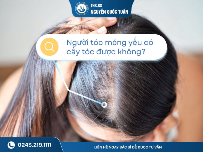người tóc mỏng yếu có cấy tóc được không