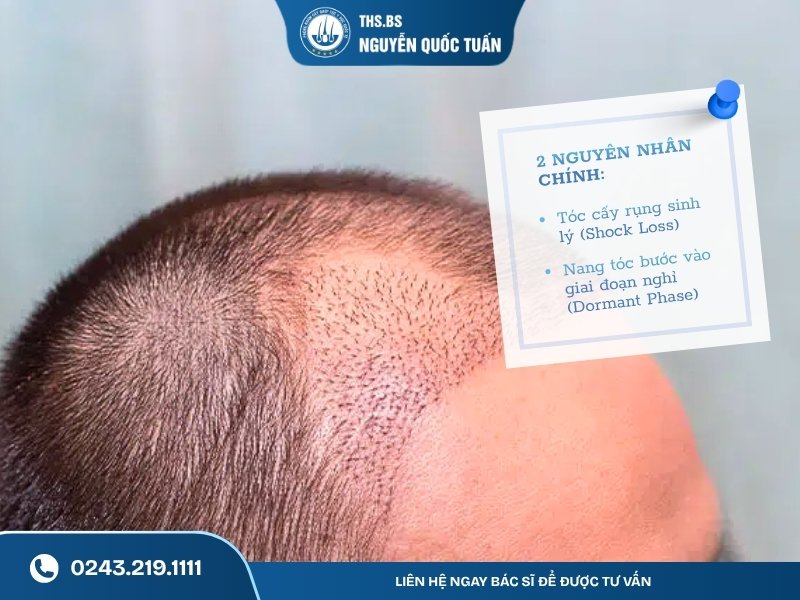 Nguyên nhân cấy tóc 1 tháng chưa mọc