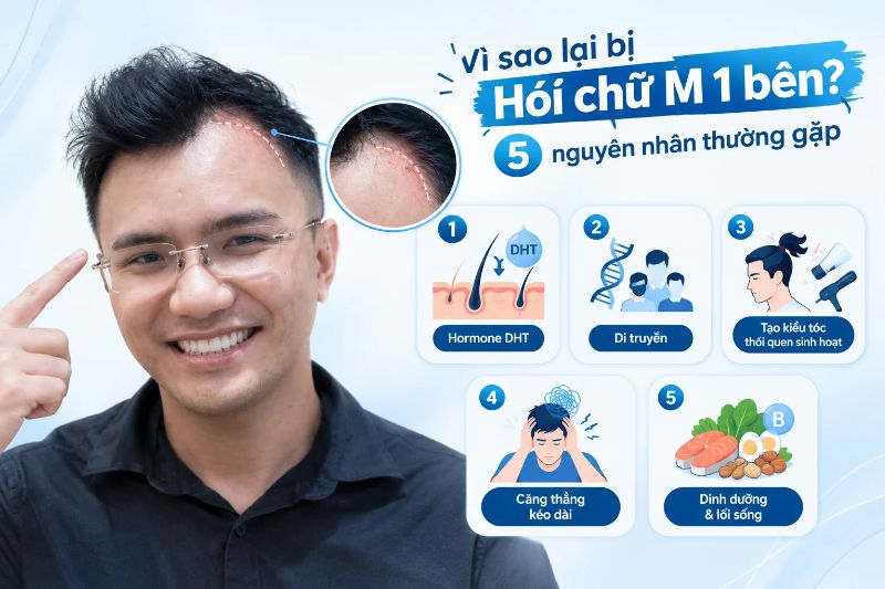 Vì sao lại bị hói chữ M 1 bên? 5 nguyên nhân thường gặp 