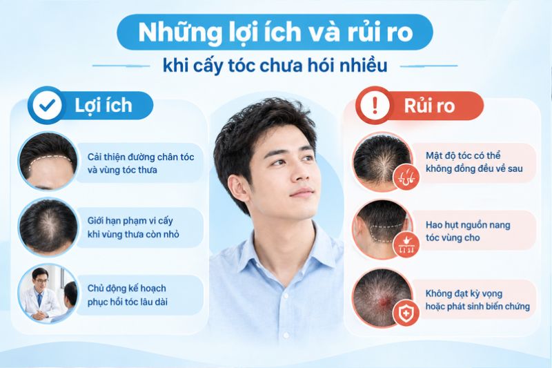 Những lợi ích và rủi ro khi cấy tóc chưa hói nhiều 