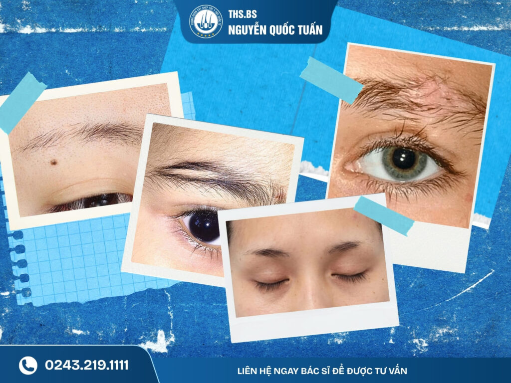 Những trường hợp nên cân nhắc cấy lông mày tự thân 