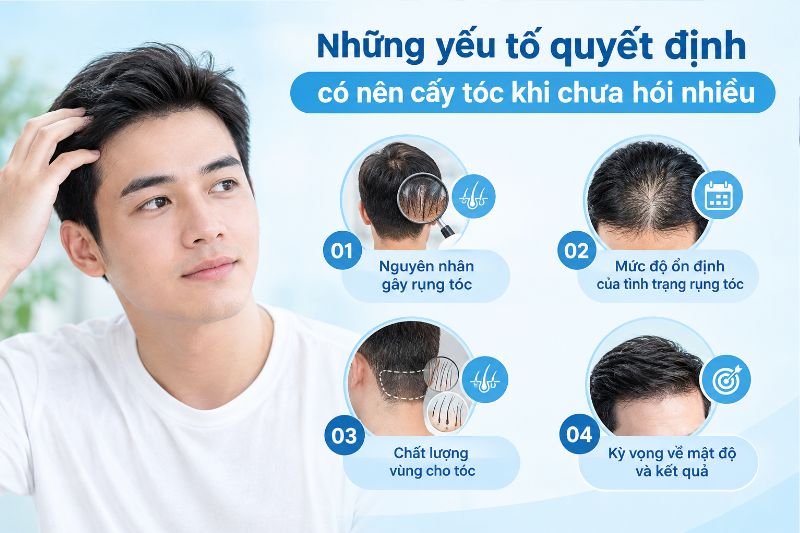 Những yếu tố quyết định có nên cấy tóc khi chưa hói nhiều 