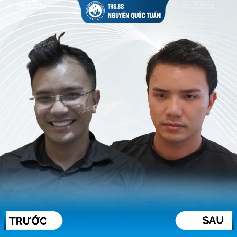 Hiệu quả sau cấy tóc tự thân  
