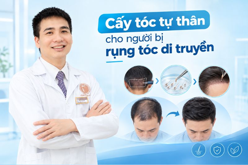  Cấy tóc tự thân cho người bị rụng tóc di truyền