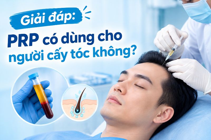  Giải đáp: PRP có dùng cho người cấy tóc không? 