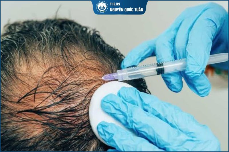 PPR trị rụng tóc có hiệu quả không?  